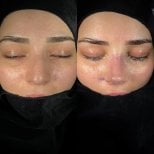 Resultados de rinoplastia antes y después, remodelación nasal natural en la clínica