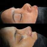 Resultados de rinoplastia antes y después, perfil y contorno nasal mejorados