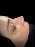 Resultado de rinoplastia mostrando perfil nasal refinado tras la cirugía