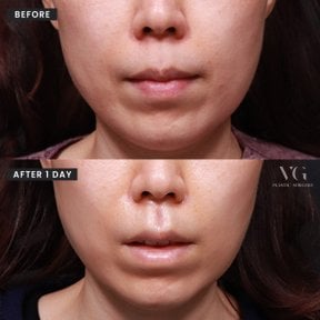 before-after photo umensenie-gub