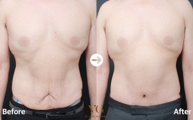 Результаты липосакции до и после в VG Plastic Surgery, улучшенный контур живота у мужчины