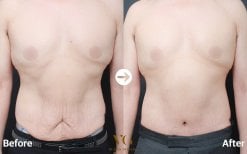 Результаты липосакции до и после в VG Plastic Surgery, улучшенный контур живота у мужчины
