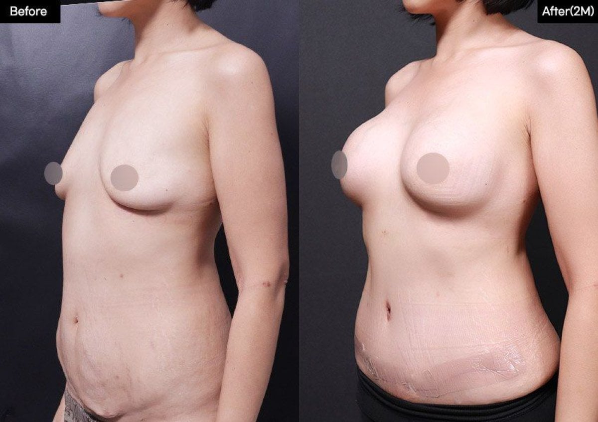 نتائج قبل وبعد شفط الدهون وتكبير الثدي في عيادة VG Plastic Surgery