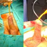Before and after penile implant surgery results at Optimed International Hospital