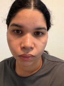 Resultado de rinoplastia de revisión en Vanity Cosmetic Surgery Center, forma de nariz mejorada