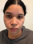Resultado de rinoplastia de revisión en Vanity Cosmetic Surgery Center, forma de nariz mejorada