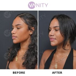 Resultados antes y después de rinoplastia secundaria en Vanity Cosmetic Surgery Center, remodelación nasal