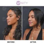 Resultados antes y después de rinoplastia secundaria en Vanity Cosmetic Surgery Center, remodelación nasal