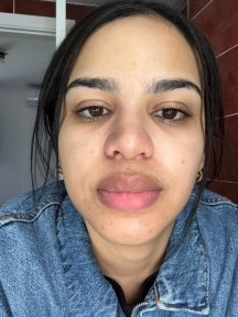 Resultado de rinoplastia secundaria en Vanity Cosmetic Surgery Center, forma de nariz mejorada