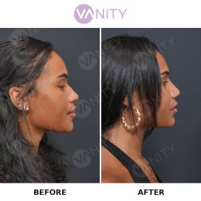 Resultados antes y después de rinoplastia secundaria en Vanity Cosmetic Surgery Center, remodelación nasal
