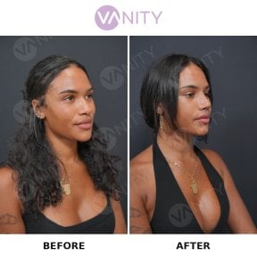 Resultados antes y después de rinoplastia secundaria en Vanity Cosmetic Surgery Center, remodelación nasal