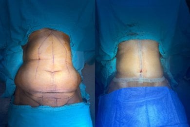 Before and after liposuction results at Optimed International Hospital, improved abdomen contour