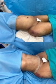 Before and after liposuction results at Optimed International Hospital, improved body contour