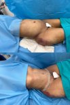 Before and after liposuction results at Optimed International Hospital, improved body contour