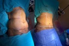 Before and after liposuction results at Optimed International Hospital, improved waist contour