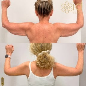 Before and after arm lift (brachioplasty) results at ID Clinic Bangkok, improved arm contour