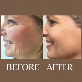 Before and after nonsurgical facelift results at ID Clinic Bangkok, smoother youthful skin