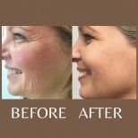 Before and after nonsurgical facelift results at ID Clinic Bangkok, smoother youthful skin