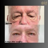 Before and after lower eyelid blepharoplasty results at ID Clinic Bangkok, reduced eye bags