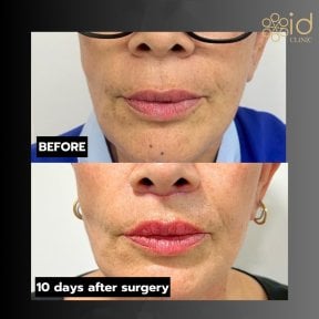 Before and after lip lift results at ID Clinic Bangkok, visible lip enhancement after 10 days