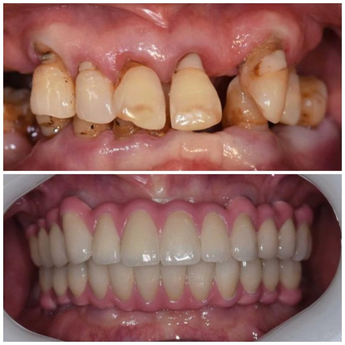 Resultados antes y después de implantes dentales en Qinghua Sunshine Dentistry (Wuhan), sonrisa restaurada