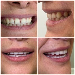 before-after photo hollywood-smile