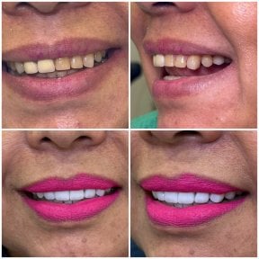 before-after photo hollywood-smile
