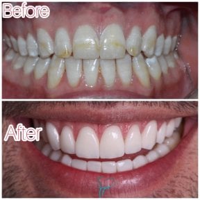 before-after photo hollywood-smile