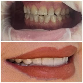 before-after photo hollywood-smile