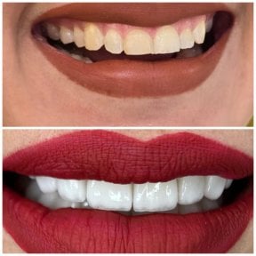 before-after photo hollywood-smile