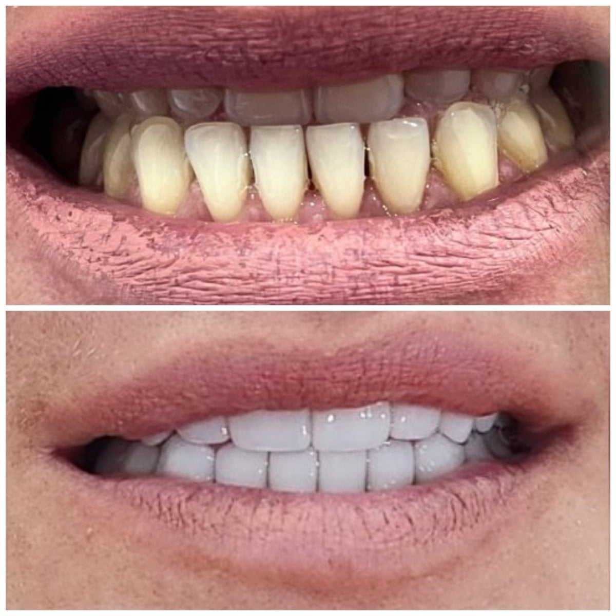 Resultados antes y después de Hollywood Smile: carillas dentales para dientes blancos y parejos
