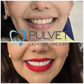 before-after photo hollywood-smile