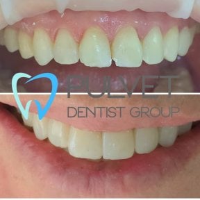 before-after photo hollywood-smile