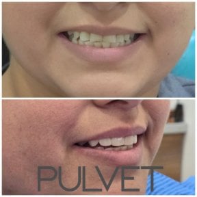 before-after photo dental-crown-installation
