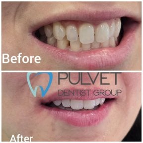 before-after photo dental-crown-installation