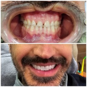 before-after photo dental-crown-installation