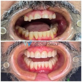 before-after photo dental-crown-installation