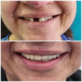 before-after photo dental-crown-installation