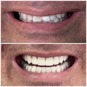 before-after photo dental-crown-installation
