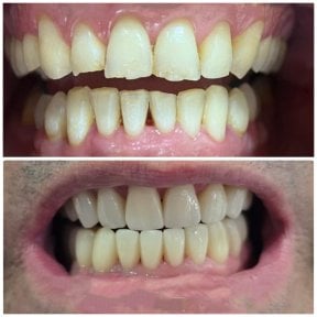 before-after photo dental-crown-installation