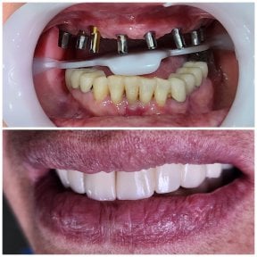 before-after photo dental-implant