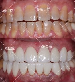 before-after photo smile-makeover