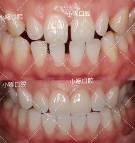 before-after photo smile-makeover
