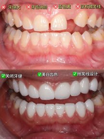 before-after photo smile-makeover