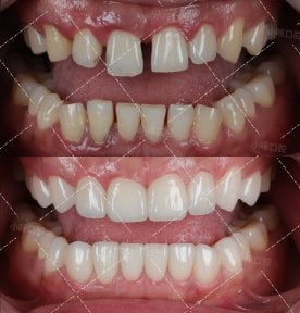before-after photo smile-makeover