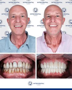 Before and after dental crown installation at Inter Dental Turkey, visible smile transformation result