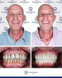 Before and after dental crown installation at Inter Dental Turkey, visible smile transformation result
