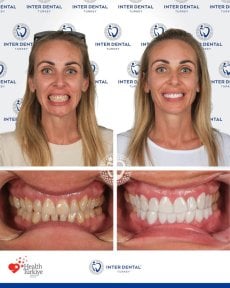Before and after dental crown installation results at Inter Dental Turkey – smile transformation