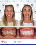 Before and after dental crown installation results at Inter Dental Turkey – smile transformation