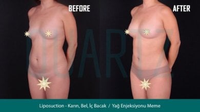 Before and after breast augmentation with fat transfer results at Quartz Hospital